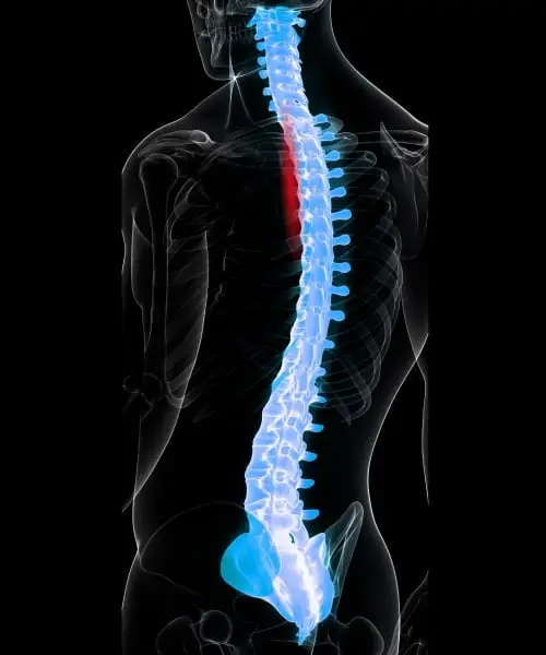 亜急性期脊髄損傷と慢性期脊髄損傷のイメージ